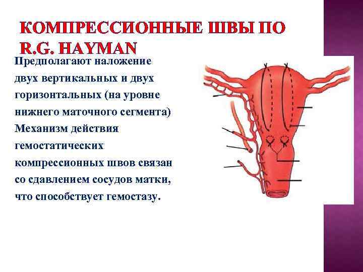 КОМПРЕССИОННЫЕ ШВЫ ПО R. G. HAYMAN Предполагают наложение двух вертикальных и двух горизонтальных (на