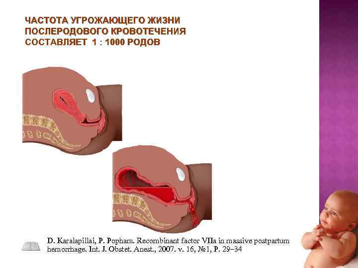 ЧАСТОТА УГРОЖАЮЩЕГО ЖИЗНИ ПОСЛЕРОДОВОГО КРОВОТЕЧЕНИЯ СОСТАВЛЯЕТ 1 : 1000 РОДОВ D. Karalapillai, P. Popham.