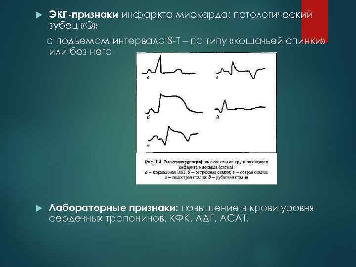 Патологический зубец q при инфаркте