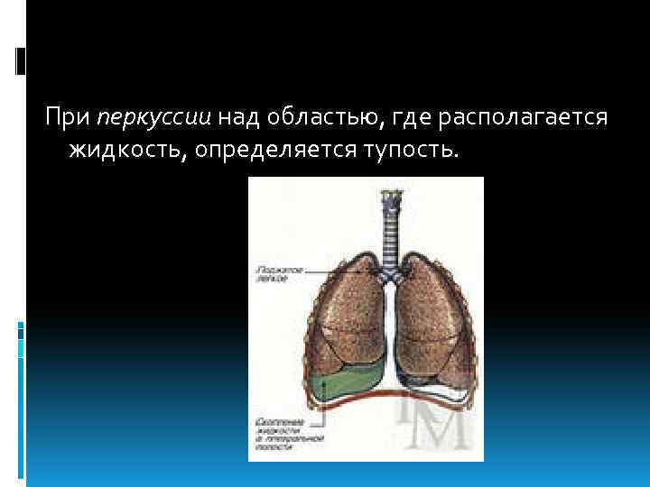 При перкуссии над областью, где располагается жидкость, определяется тупость. 