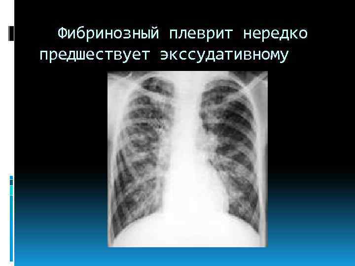 Фибринозный плеврит нередко предшествует экссудативному 