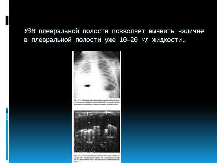 УЗИ плевральной полости позволяет выявить наличие в плевральной полости уже 10— 20 мл жидкости.