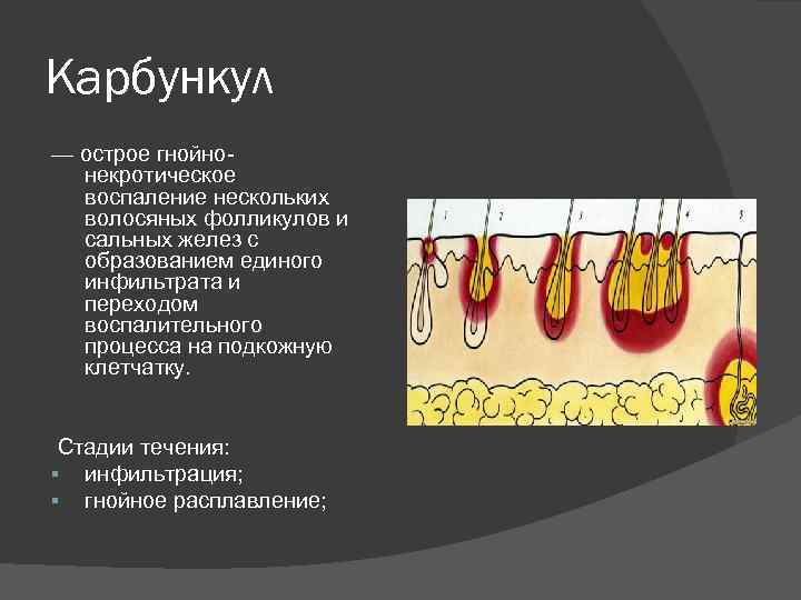 Карбункул — острое гнойнонекротическое воспаление нескольких волосяных фолликулов и сальных желез с образованием единого