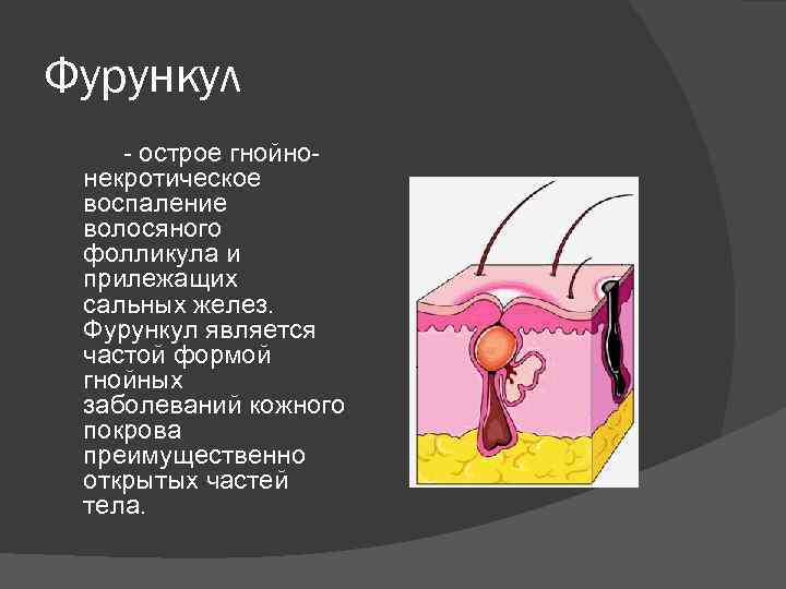 Фурункул - острое гнойнонекротическое воспаление волосяного фолликула и прилежащих сальных желез. Фурункул является частой