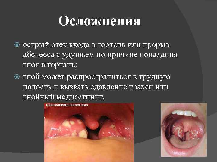 Осложнения острый отек входа в гортань или прорыв абсцесса с удушьем по причине попадания