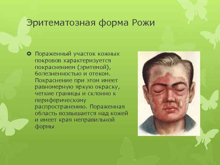 Эритематозная форма Рожи Пораженный участок кожных покровов характеризуется покраснением (эритемой), болезненностью и отеком. Покраснение