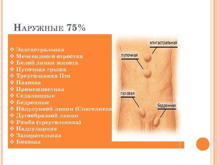 НАРУЖНЫЕ 75% v v v v Эпигастральная Мечевидного отростка Белой линии живота Пупочная грыжа