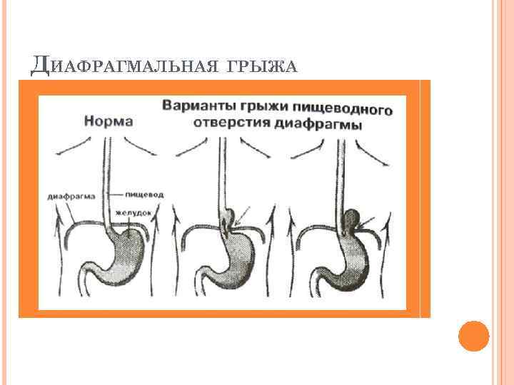 ДИАФРАГМАЛЬНАЯ ГРЫЖА 