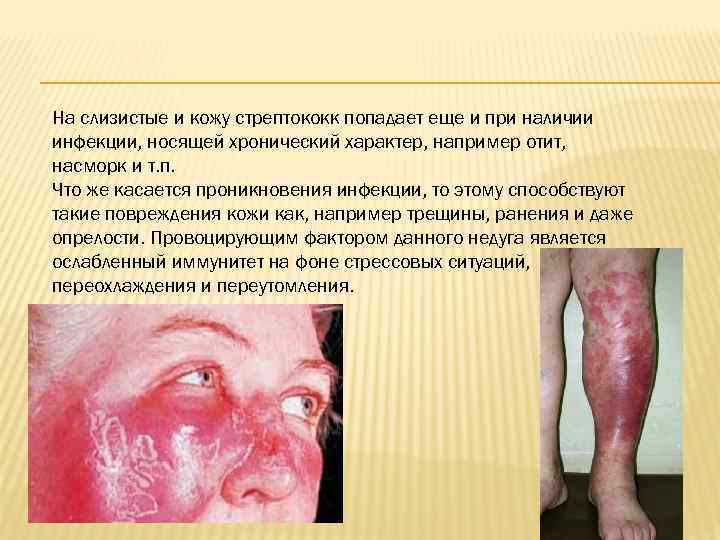 На слизистые и кожу стрептококк попадает еще и при наличии инфекции, носящей хронический характер,