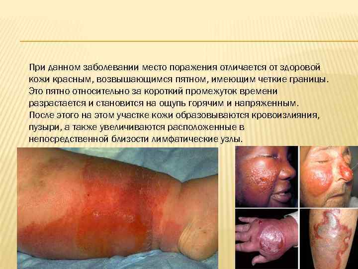 При данном заболевании место поражения отличается от здоровой кожи красным, возвышающимся пятном, имеющим четкие