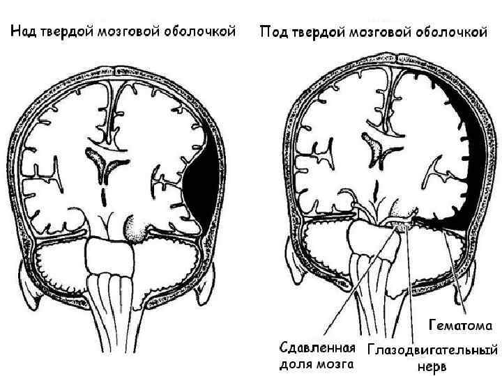 Клиническая картина сдавление головного мозга