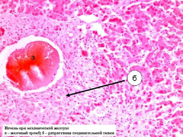 Печень при механической желтухе а – желчный тромб; б – разрастания соединительной ткани 