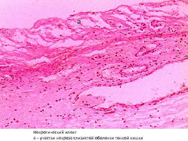 Некротический илеит а – участки некроза слизистой оболочки тонкой кишки 