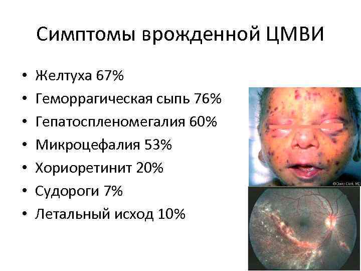 Симптомы врожденной ЦМВИ • • Желтуха 67% Геморрагическая сыпь 76% Гепатоспленомегалия 60% Микроцефалия 53%