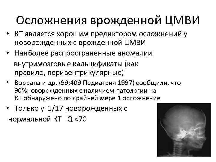 Осложнения врожденной ЦМВИ • КТ является хорошим предиктором осложнений у новорожденных с врожденной ЦМВИ