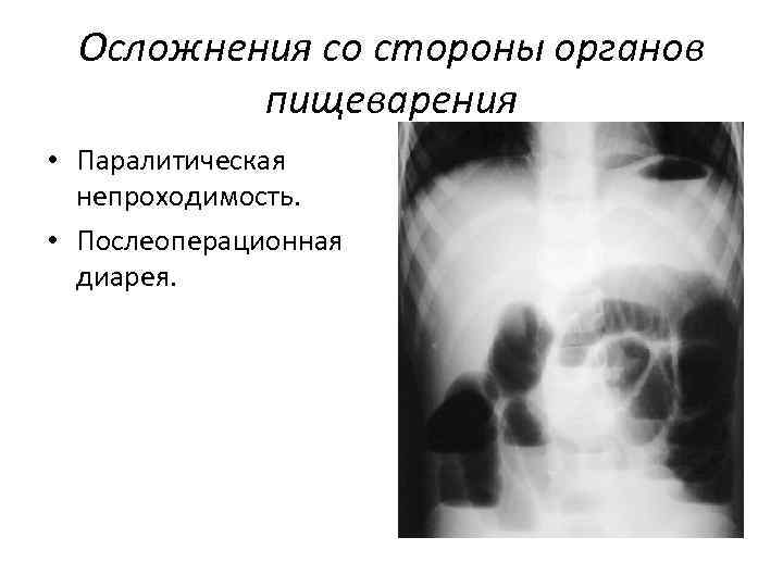 Осложнения со стороны органов пищеварения • Паралитическая непроходимость. • Послеоперационная диарея. 