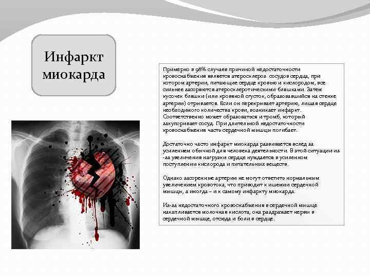 Инфаркт миокарда Примерно в 98% случаев причиной недостаточности кровоснабжения является атеросклероз сосудов сердца, при