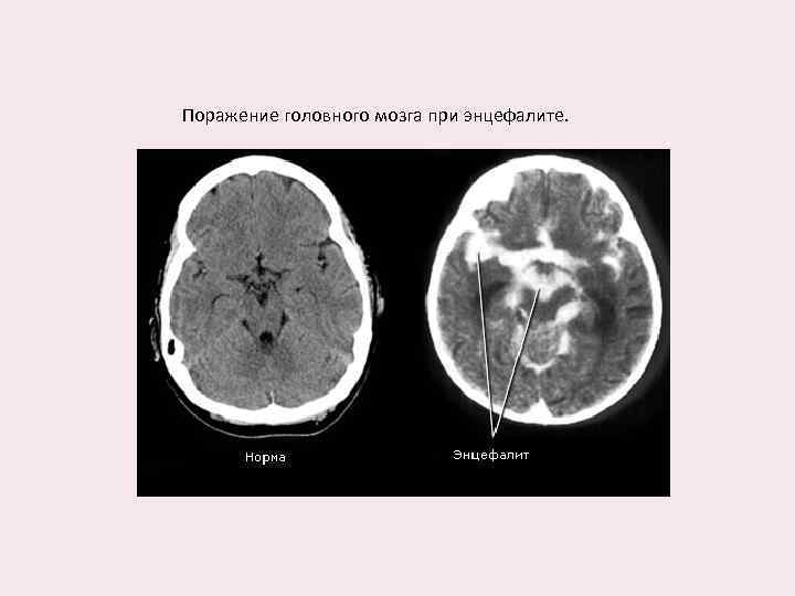 Поражение головного мозга при энцефалите. 