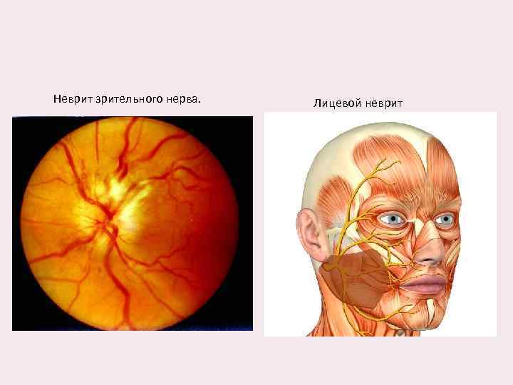 Неврит зрительного нерва. Лицевой неврит 