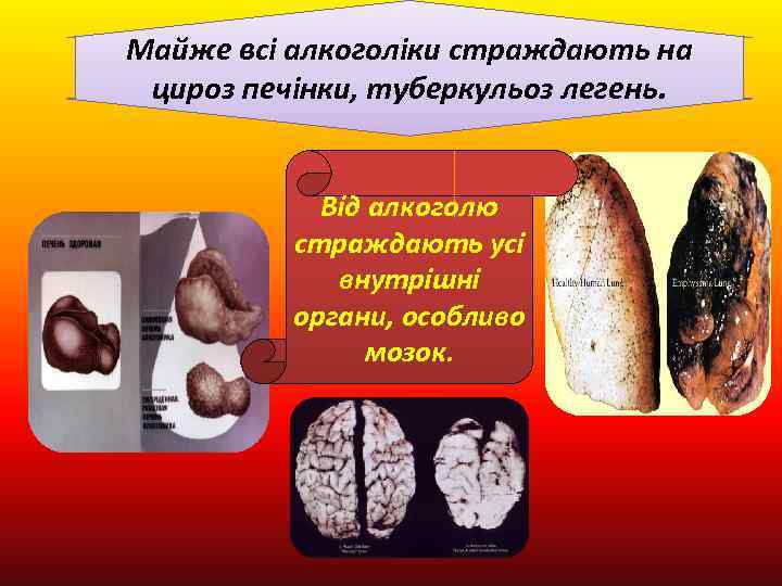 Майже всі алкоголіки страждають на цироз печінки, туберкульоз легень. Від алкоголю страждають усі внутрішні