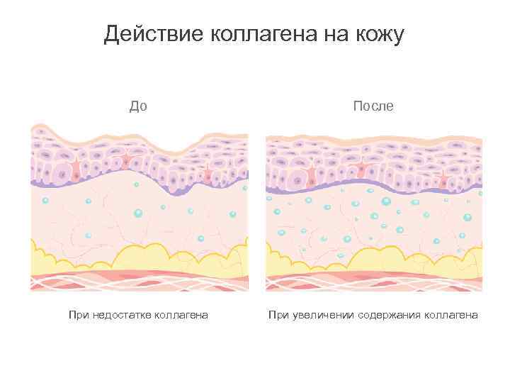 Действие коллагена на кожу До После При недостатке коллагена При увеличении содержания коллагена 