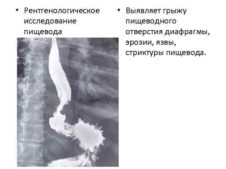 Рентгеноскопия пищевода и желудка с барием