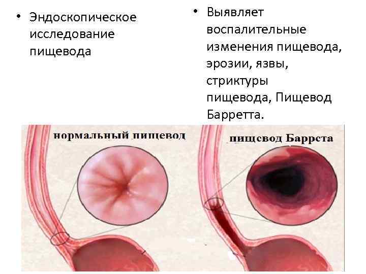 Диета при эрозии пищевода