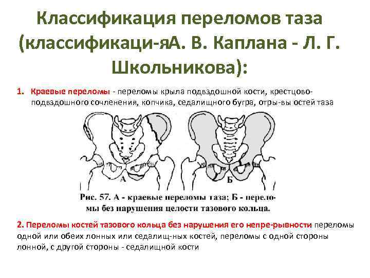 Классификация переломов таза (классификаци я . В. Каплана Л. Г. А Школьникова): 1. Краевые