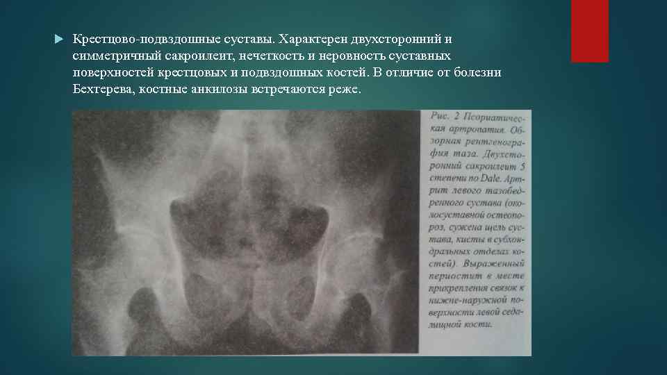  Крестцово-подвздошные суставы. Характерен двухсторонний и симметричный сакроилеит, нечеткость и неровность суставных поверхностей крестцовых