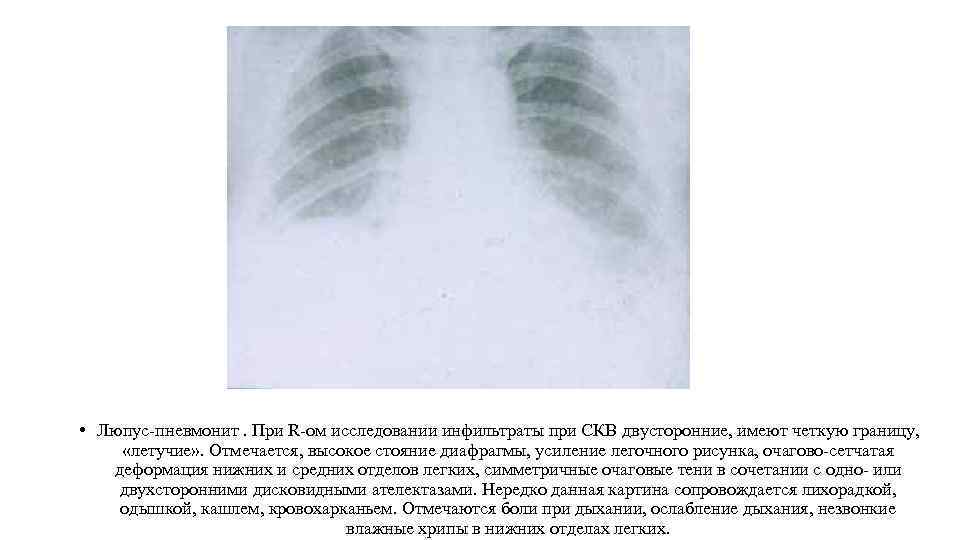  • Люпус-пневмонит. При R-ом исследовании инфильтраты при СКВ двусторонние, имеют четкую границу, «летучие»