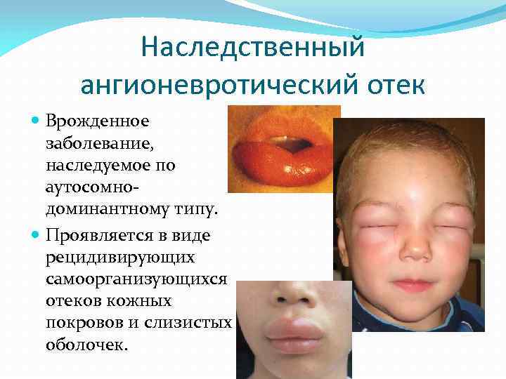 Наследственный ангионевротический отек Врожденное заболевание, наследуемое по аутосомнодоминантному типу. Проявляется в виде рецидивирующих самоорганизующихся