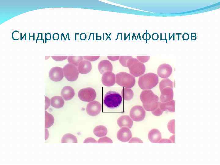 Синдром голых лимфоцитов 