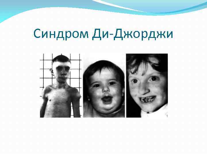 Синдром Ди-Джорджи 