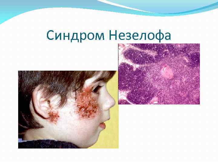 Синдром Незелофа 