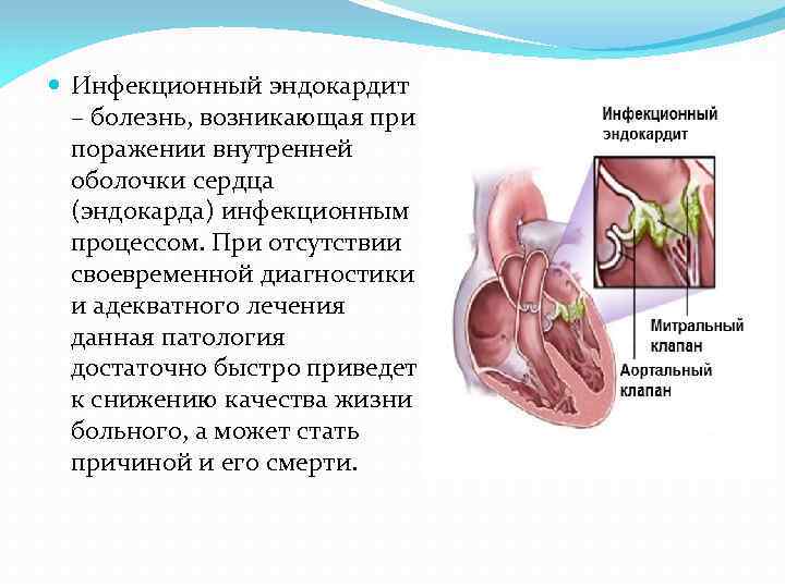  Инфекционный эндокардит – болезнь, возникающая при поражении внутренней оболочки сердца (эндокарда) инфекционным процессом.