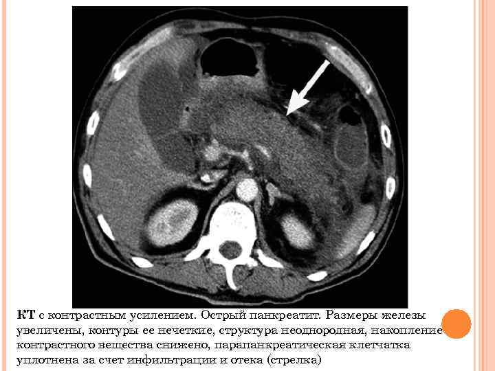 КТ с контрастным усилением. Острый панкреатит. Размеры железы увеличены, контуры ее нечеткие, структура неоднородная,