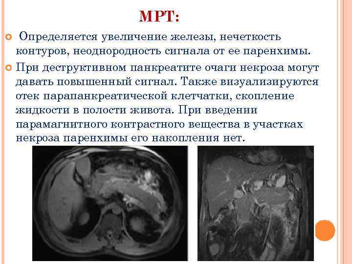 МРТ: Определяется увеличение железы, нечеткость контуров, неоднородность сигнала от ее паренхимы. При деструктивном панкреатите