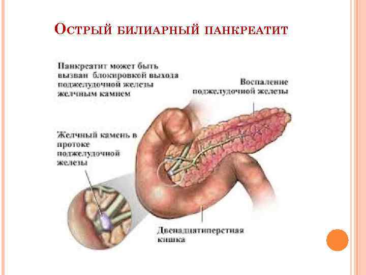 ОСТРЫЙ БИЛИАРНЫЙ ПАНКРЕАТИТ 