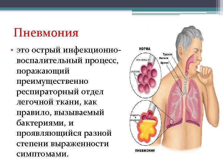 Пневмония • это острый инфекционновоспалительный процесс, поражающий преимущественно респираторный отдел легочной ткани, как правило,