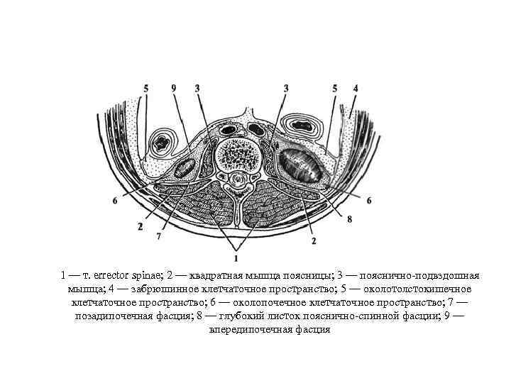 1 — т. errector spinae; 2 — квадратная мышца поясницы; 3 — пояснично-подвздошная мышца;