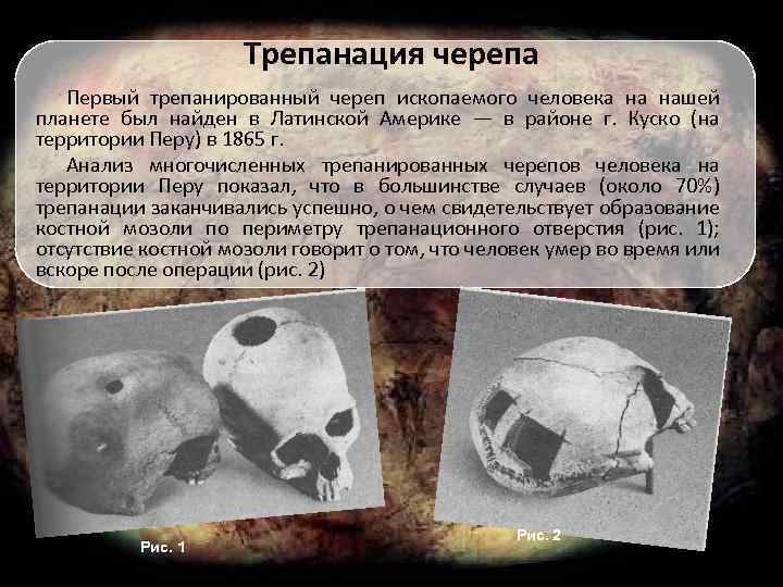 Трепанация черепа Первый трепанированный череп ископаемого человека на нашей планете был найден в Латинской