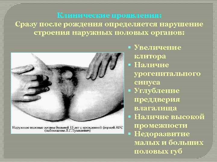 Клинические проявления: Сразу после рождения определяется нарушение строения наружных половых органов: § Увеличение клитора