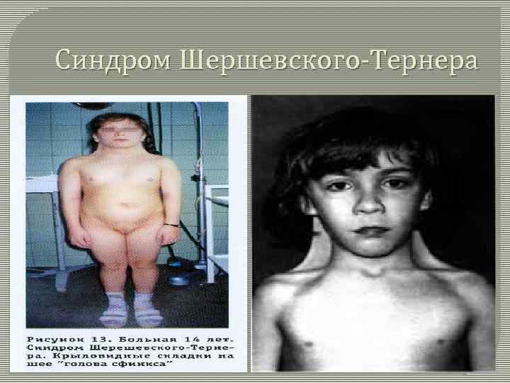 Синдром Шершевского-Тернера 