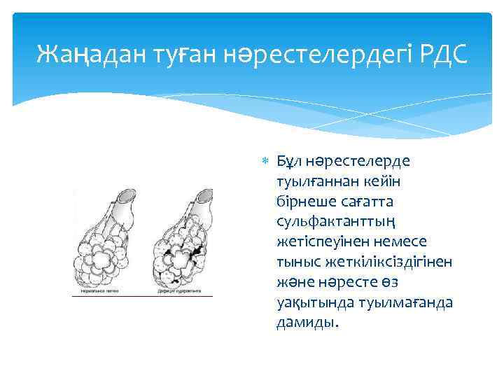 Жаңадан туған нәрестелердегі РДС Бұл нәрестелерде туылғаннан кейін бірнеше сағатта сульфактанттың жетіспеуінен немесе тыныс