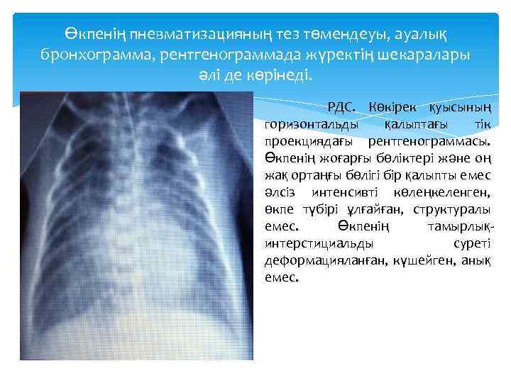 Өкпенің пневматизацияның тез төмендеуы, ауалық бронхограмма, рентгенограммада жүректің шекаралары әлі де көрінеді. РДС. Көкірек