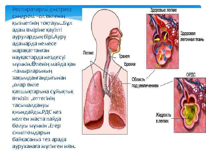 Респираторлы дистресс синдром –ол өкпенің қызметінің тоқтауы. . Бұл адам өміріне қауіпті аурулардың бірі.