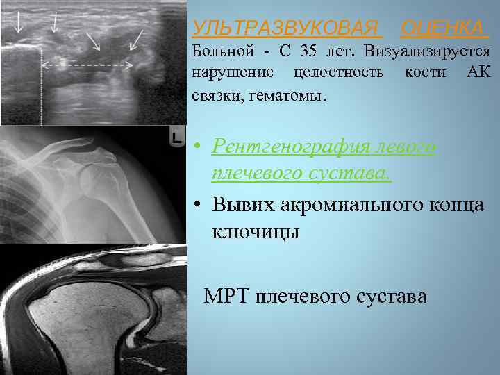 УЛЬТРАЗВУКОВАЯ ОЦЕНКА Больной - С 35 лет. Визуализируется нарушение целостность кости АК связки, гематомы.