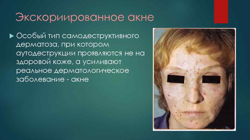 Экскориированное акне Особый тип самодеструктивного дерматоза, при котором аутодеструкции проявляются не на здоровой коже,