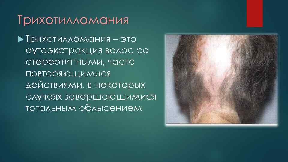 Трихотилломания – это аутоэкстракция волос со стереотипными, часто повторяющимися действиями, в некоторых случаях завершающимися