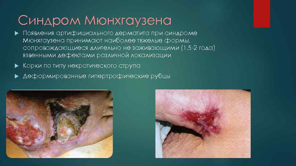 Синдром Мюнхгаузена Появления артифициального дерматита при синдроме Мюнхгаузена принимают наиболее тяжелые формы, сопровождающиеся длительно